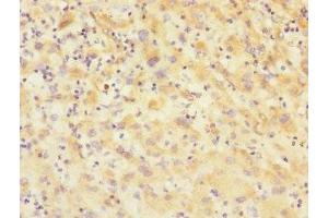 Immunohistochemistry of paraffin-embedded human lung cancer using ABIN7175348 at dilution of 1:100