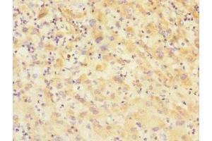 Immunohistochemistry of paraffin-embedded human lung cancer using ABIN7175348 at dilution of 1:100 (VARS anticorps  (AA 1-280))