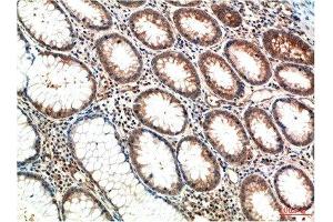 Immunohistochemical analysis of paraffin-embedded Human Colon Carcinoma Tissue using ATM Mouse mAb diluted at 1:200.