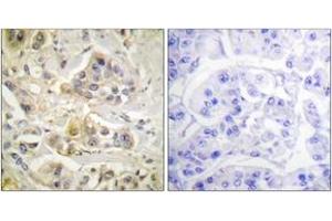 Immunohistochemistry analysis of paraffin-embedded human breast carcinoma tissue, using AhR (Ab-36) Antibody. (Aryl Hydrocarbon Receptor anticorps  (AA 2-51))