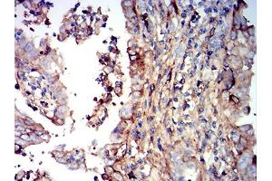 Immunohistochemical analysis of paraffin-embedded endometrial cancer tissues using IGHM mouse mAb with DAB staining. (IGHM anticorps  (AA 310-452))