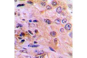 Immunohistochemical analysis of DUSP6 staining in human lung cancer formalin fixed paraffin embedded tissue section.