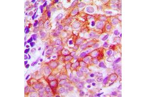 Immunohistochemical analysis of Beta-2 Adrenergic Receptor staining in human prostate cancer formalin fixed paraffin embedded tissue section. (beta 2 Adrenergic Receptor anticorps  (C-Term))