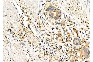 ABIN6263511 and ABIN6276331 at 1/100 staining Human esophageal cancer by IHC-P.