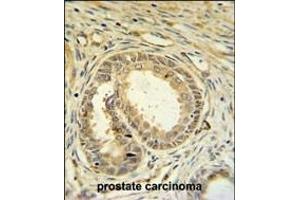 SPDYA Antibody (Center) (ABIN6244012 and ABIN6579062) IHC analysis in formalin fixed and paraffin embedded prostate carcinoma followed by peroxidase conjugation of the secondary antibody and DAB staining.