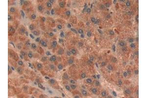 Detection of RORg in Human Liver cancer Tissue using Polyclonal Antibody to RAR Related Orphan Receptor Gamma (RORg)