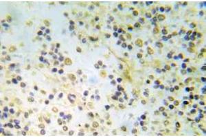Immunohistochemistry (IHC) analyzes of p-ER-a (pSer118) pAb in paraffin-embedded human breast carcinoma tissue. (Estrogen Receptor alpha anticorps  (pSer118))