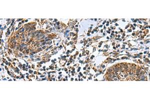 Immunohistochemistry of paraffin-embedded Human esophagus cancer tissue using MRPL40 Polyclonal Antibody at dilution of 1:80(x200)