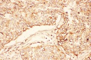 Anti-AKT2 Picoband antibody,  IHC(P): Human Lung Cancer Tissue (AKT2 anticorps  (C-Term))