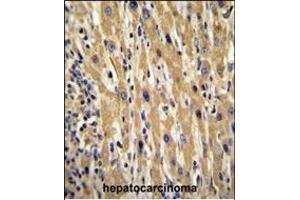 GAL Antibody (Center) (ABIN655055 and ABIN2844684) immunohistochemistry analysis in formalin fixed and paraffin embedded human hepatocarcinoma followed by peroxidase conjugation of the secondary antibody and DAB staining. (GAL anticorps  (AA 48-79))