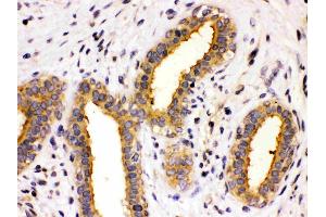 TCP1 theta was detected in paraffin-embedded sections of human mammary cancer tissues using rabbit anti- TCP1 theta Antigen Affinity purified polyclonal antibody (Catalog # ) at 1 µg/mL.