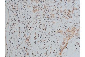 ABIN6267039 at 1/200 staining human breast cancer tissue sections by IHC-P. (Histone 3 anticorps)