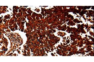 Immunohistochemistry of paraffin-embedded Human lung cancer tissue using ANXA7 Polyclonal Antibody at dilution 1:40 (Annexin VII anticorps)