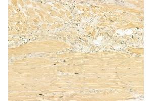 ABIN6260791 and ABIN6273208 at 1/100 staining human tongue carcinoma by IHC-P. (CHCHD4 anticorps  (N-Term))