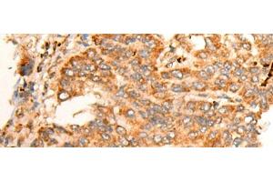 Immunohistochemistry of paraffin-embedded Human liver cancer tissue using BPGM Polyclonal Antibody at dilution of 1:70(x200) (BPGM anticorps)
