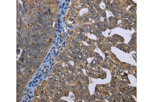 Immunohistochemistry of Human gastric cancer using GPAM Polyclonal Antibody at dilution of 1:60