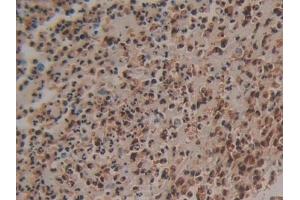 Detection of S100P in Human Colorectal cancer Tissue using Polyclonal Antibody to S100 Calcium Binding Protein P (S100P)