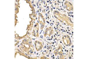 Immunohistochemistry of paraffin-embedded human kidney cancer using ARRB2 antibody (ABIN6290073) at dilution of 1:200 (40x lens). (Arrestin 3 anticorps)
