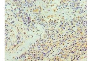 Immunohistochemistry of paraffin-embedded human breast cancer using ABIN7172210 at dilution of 1:100 (TFPI2 anticorps  (AA 23-235))