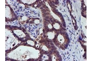 Immunohistochemical staining of paraffin-embedded Adenocarcinoma of Human colon tissue using anti-SMS mouse monoclonal antibody. (SMS anticorps)
