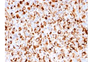 Formalin-fixed, paraffin-embedded human Melanoma stained with NGFR Mouse Recombinant Monoclonal Antibody (rNGFR/1965).