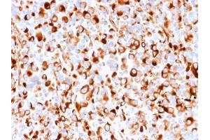 Formalin-fixed, paraffin-embedded human Melanoma stained with NGFR Mouse Recombinant Monoclonal Antibody (rNGFR/1965). (Recombinant NGFR anticorps  (AA 281-421))