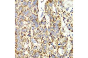 Immunohistochemistry of paraffin-embedded human lung cancer using UGDH antibody (ABIN6293152) at dilution of 1:100 (40x lens). (UGDH anticorps)