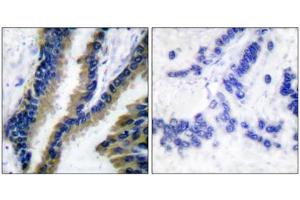Immunohistochemical analysis of paraffin-embedded human lung carcinoma tissue using VAV1 (epitope around residue 174) antibody (ABIN5976238).