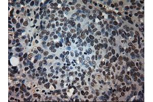 Immunohistochemical staining of paraffin-embedded Adenocarcinoma of colon tissue using anti-PROM2mouse monoclonal antibody. (Prominin 2 anticorps)