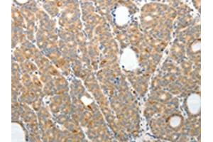 The image on the left is immunohistochemistry of paraffin-embedded Human thyroid cancer tissue using (TEP1 Antibody) at dilution 1/50, on the right is treated with synthetic peptide. (TEP1 anticorps)