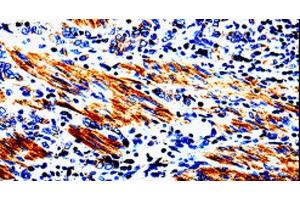 Immunohistochemistry of paraffin-embedded Human stomach cancer tissue using ACSBG2 Polyclonal Antibody at dilution 1:60 (ACSBG2 anticorps)