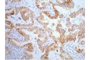 IHC staining of human lung cancer tissue, diluted at 1:200. (Cytokeratin 7 anticorps)