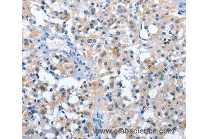 Immunohistochemistry of Human thyroid cancer using ASB2 Polyclonal Antibody at dilution of 1:50 (ASB2 anticorps)