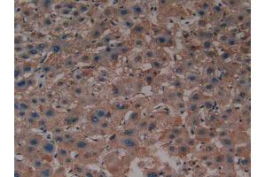 IHC-P analysis of Human Liver Cancer Tissue, with DAB staining. (Sonic Hedgehog anticorps  (AA 36-193))