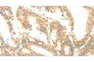Immunohistochemistry of paraffin-embedded Human colon cancer tissue using P23 Polyclonal Antibody at dilution 1:50 (CDK5R1 anticorps)