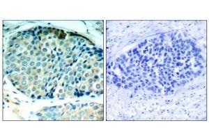 Immunohistochemical analysis of paraffin-embedded human breast carcinoma tissue, using HSP27 (phospho- Ser78) antibody (E011247). (HSP27 anticorps  (pSer78))