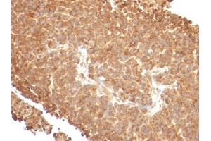 Formalin-fixed, paraffin-embedded human Melanoma stained with Topo I, MT Mouse Monoclonal Antibody (TOPT/488).