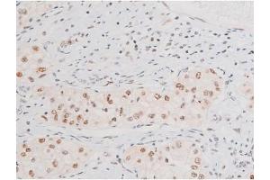 ABIN6267602 at 1/200 staining Human kidney cancer tissue sections by IHC-P.