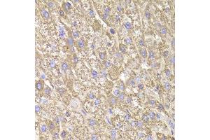 Immunohistochemistry of paraffin-embedded human liver injury using CIAPIN1 Antibody. (CIAPIN1 anticorps  (AA 1-312))