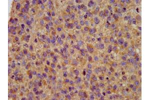 IHC image of ABIN7163983 diluted at 1:200 and staining in paraffin-embedded human glioma performed on a Leica BondTM system. (Kcne3 anticorps  (AA 1-57))