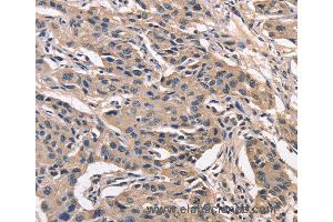 Immunohistochemistry of Human lung cancer using PEBP1 Polyclonal Antibody at dilution of 1:40 (PEBP1 anticorps)