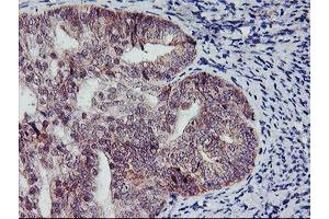 Immunohistochemical staining of paraffin-embedded Adenocarcinoma of Human endometrium tissue using anti-NAPEPLD mouse monoclonal antibody.