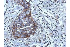 AP31123PU-N RGS4 antibody staining of Paraffin-Embedded Breast Carcinoma at 1/500 dilution.