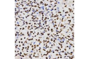 Immunohistochemistry of paraffin-embedded human kidney cancer using Dimethyl-Histone H3-K4 antibody (ABIN5969803) at dilution of 1/200 (40x lens). (Histone 3 anticorps  (H3K4me2))