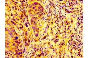 IHC image of ABIN7145776 diluted at 1:100 and staining in paraffin-embedded human pancreatic cancer performed on a Leica BondTM system.