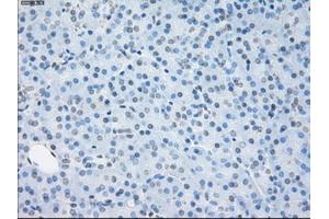 Immunohistochemical staining of paraffin-embedded Adenocarcinoma of ovary tissue using anti-SORDmouse monoclonal antibody. (SORD anticorps)