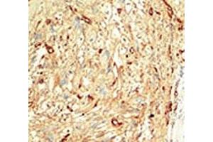 IHC analysis of FFPE human breast carcinoma tissue stained with the MST1 antibody
