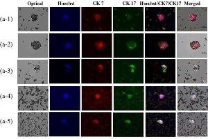 On-chip cholangiocarcinoma (CCA) cell capture and consequent immunofluorescence (IF) staining with CCA-specific biomarkers (CK7 and CK17).