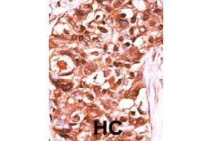 Formalin-fixed and paraffin-embedded human hepatocellular carcinoma tissue reacted with STAT5A (phospho Y694) polyclonal antibody  which was peroxidase-conjugated to the secondary antibody followed by DAB staining. (STAT5A anticorps  (pTyr694))