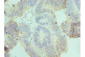 Immunohistochemistry of paraffin-embedded human colon cancer using ABIN7149071 at dilution of 1:100 (AXUD1 anticorps  (AA 1-200))